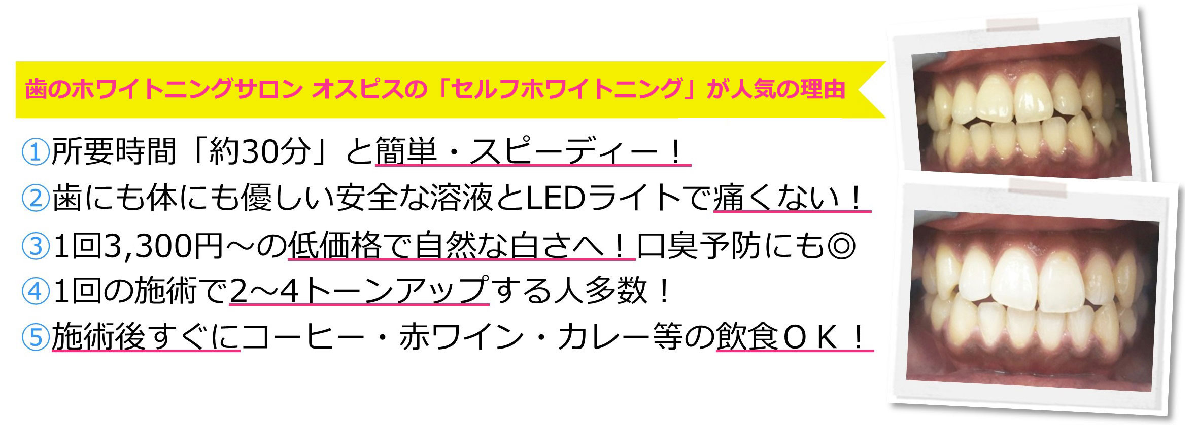 歯のホワイトニングサロン オスピスの「セルフホワイトニング」が人気の理由